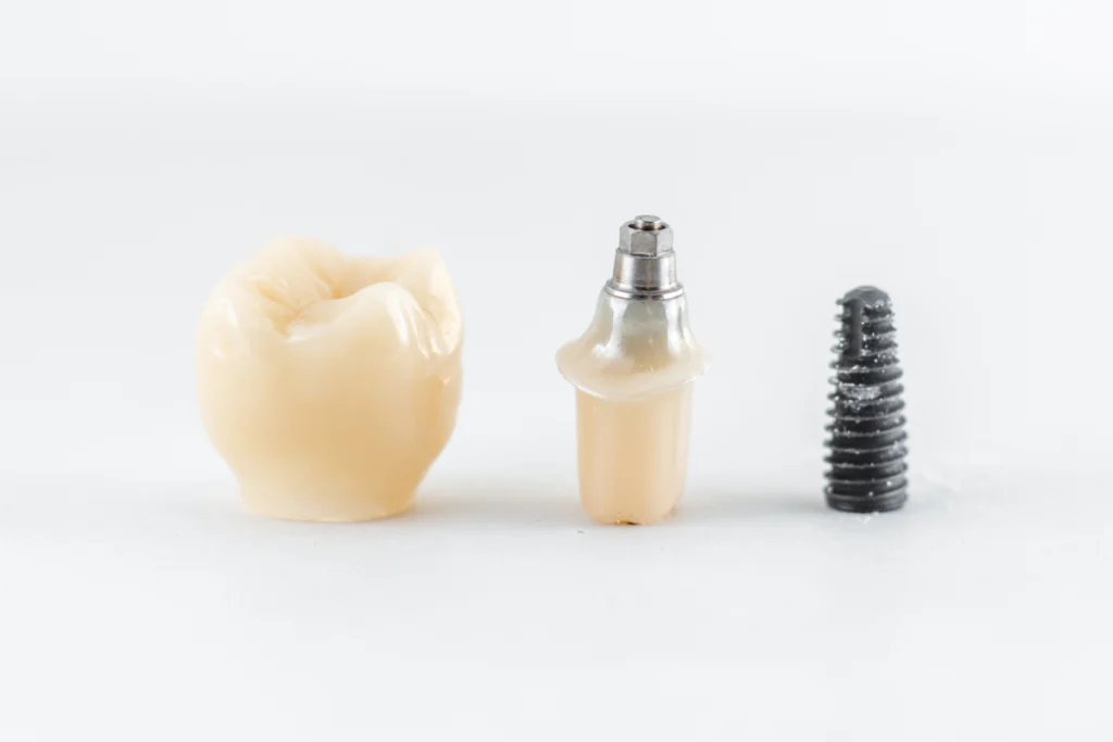 couronne implant dentaire Implants dentaires Laboratoire Émail Santé