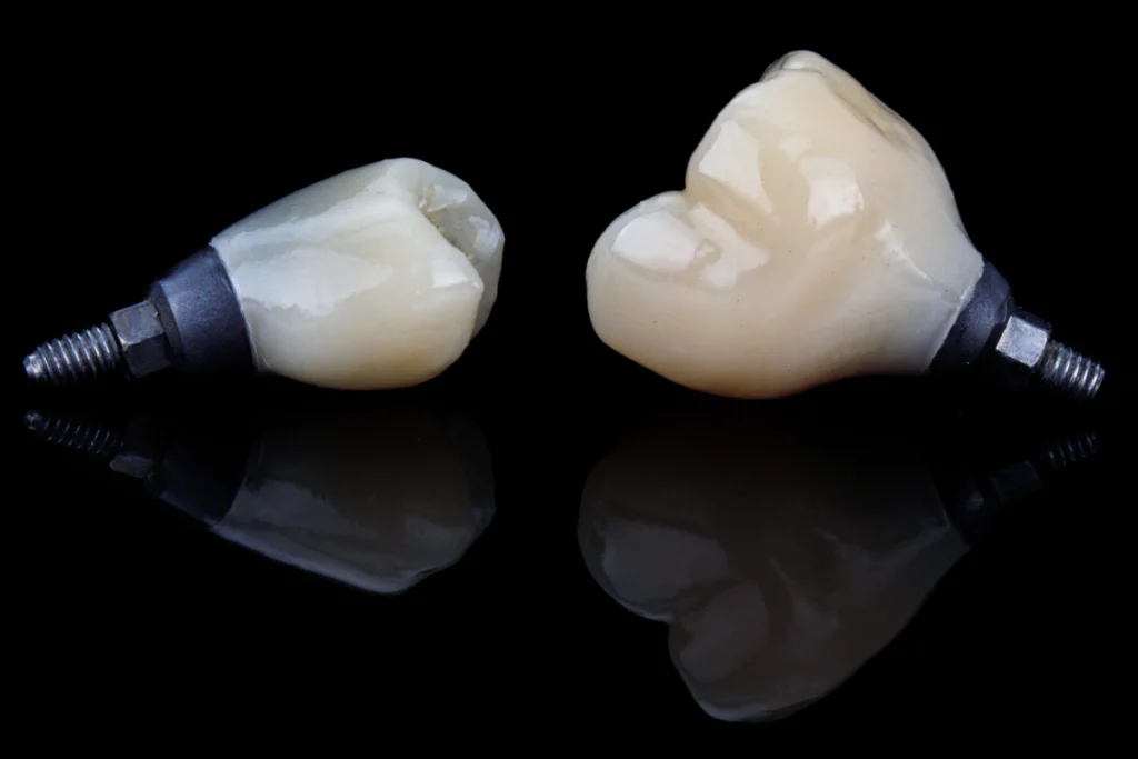 couronne implant dentaire Implants dentaires Laboratoire Émail Santé