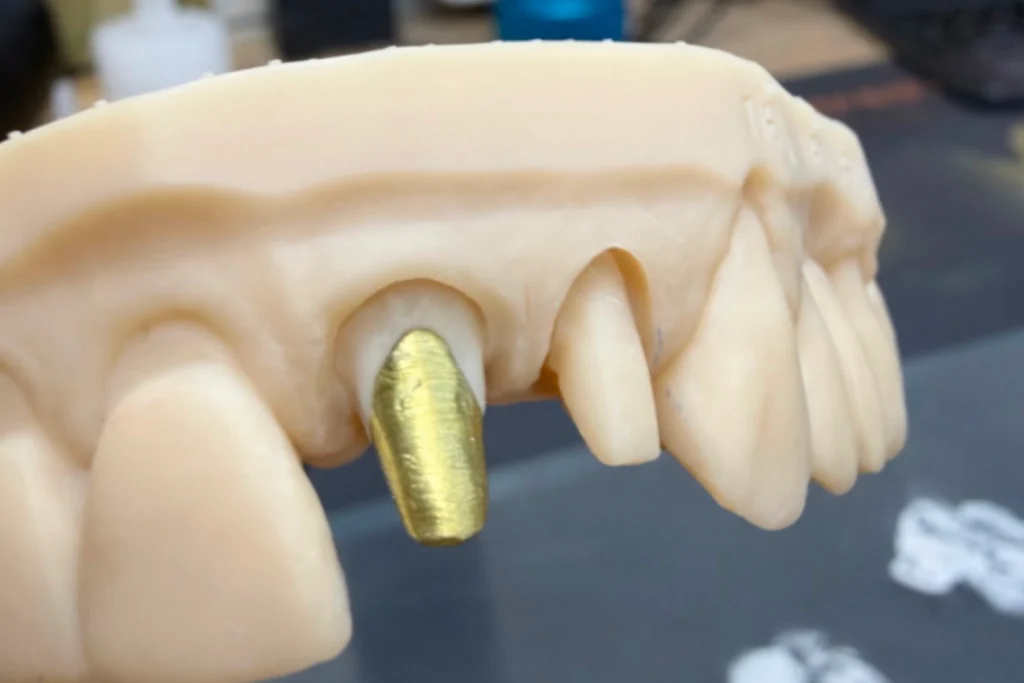 inlays onlays cores titane anodise Prothèses fixes Laboratoire Émail Santé