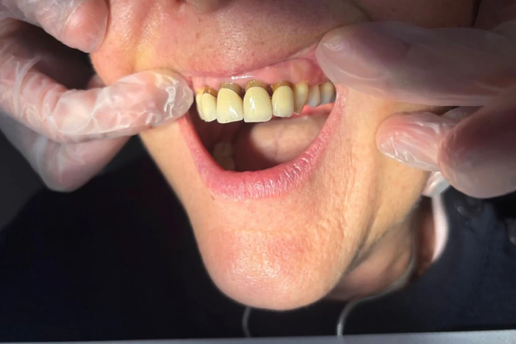 laboratoire dentaire email sante nantes Prothèses fixes Laboratoire Émail Santé