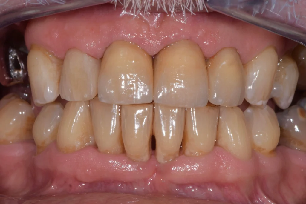 laboratoire dentaire email sante nantes Prothèses fixes Laboratoire Émail Santé