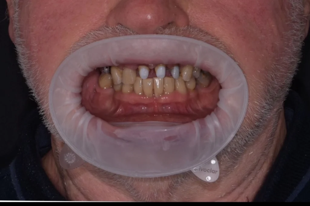 laboratoire dentaire email sante nantes Prothèses fixes Laboratoire Émail Santé