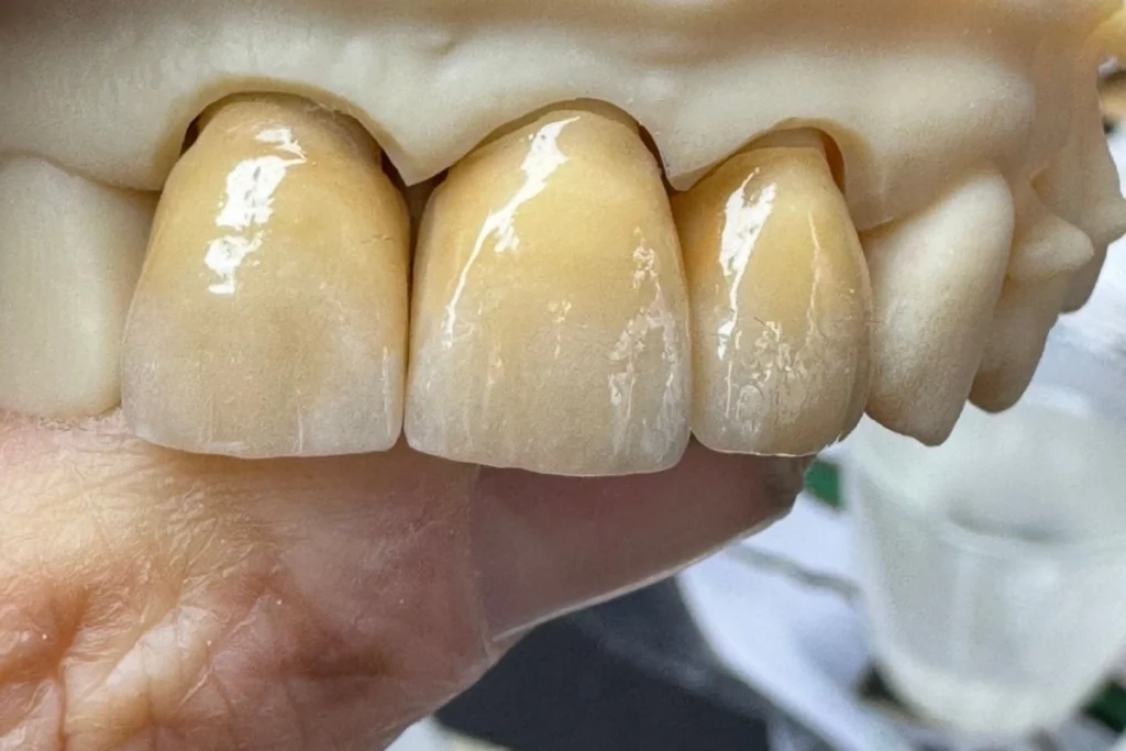 laboratoire dentaire email sante nantes Prothèses fixes Laboratoire Émail Santé