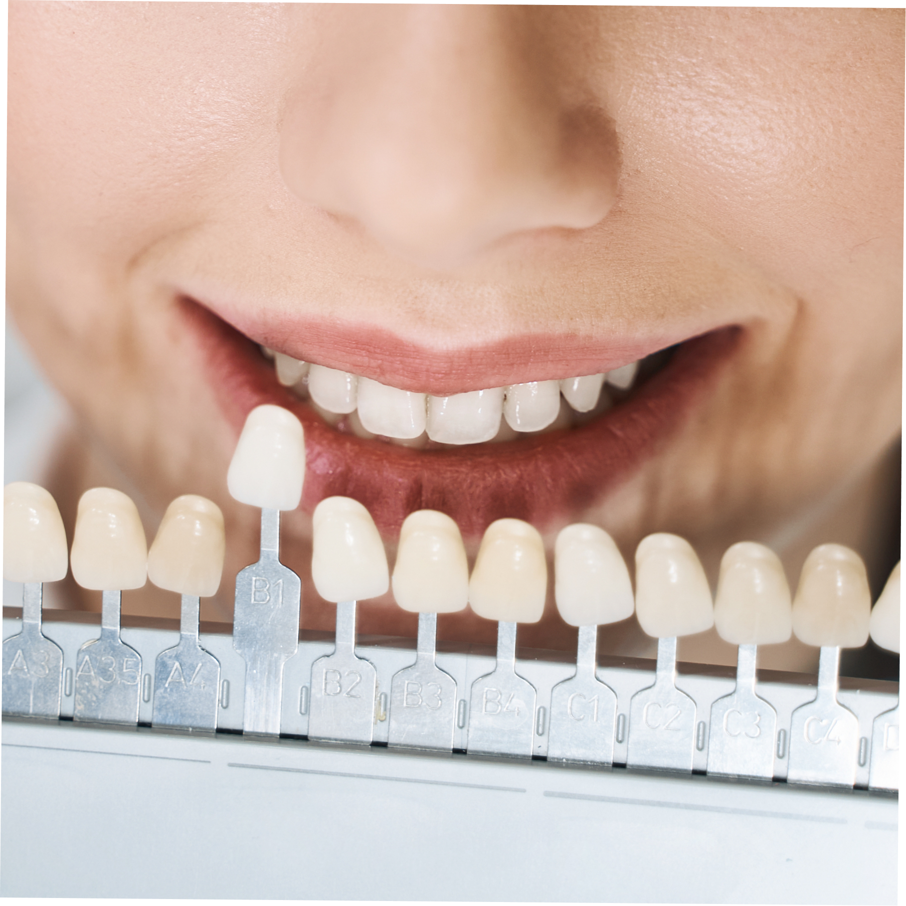 facette-dentaire-bretagne